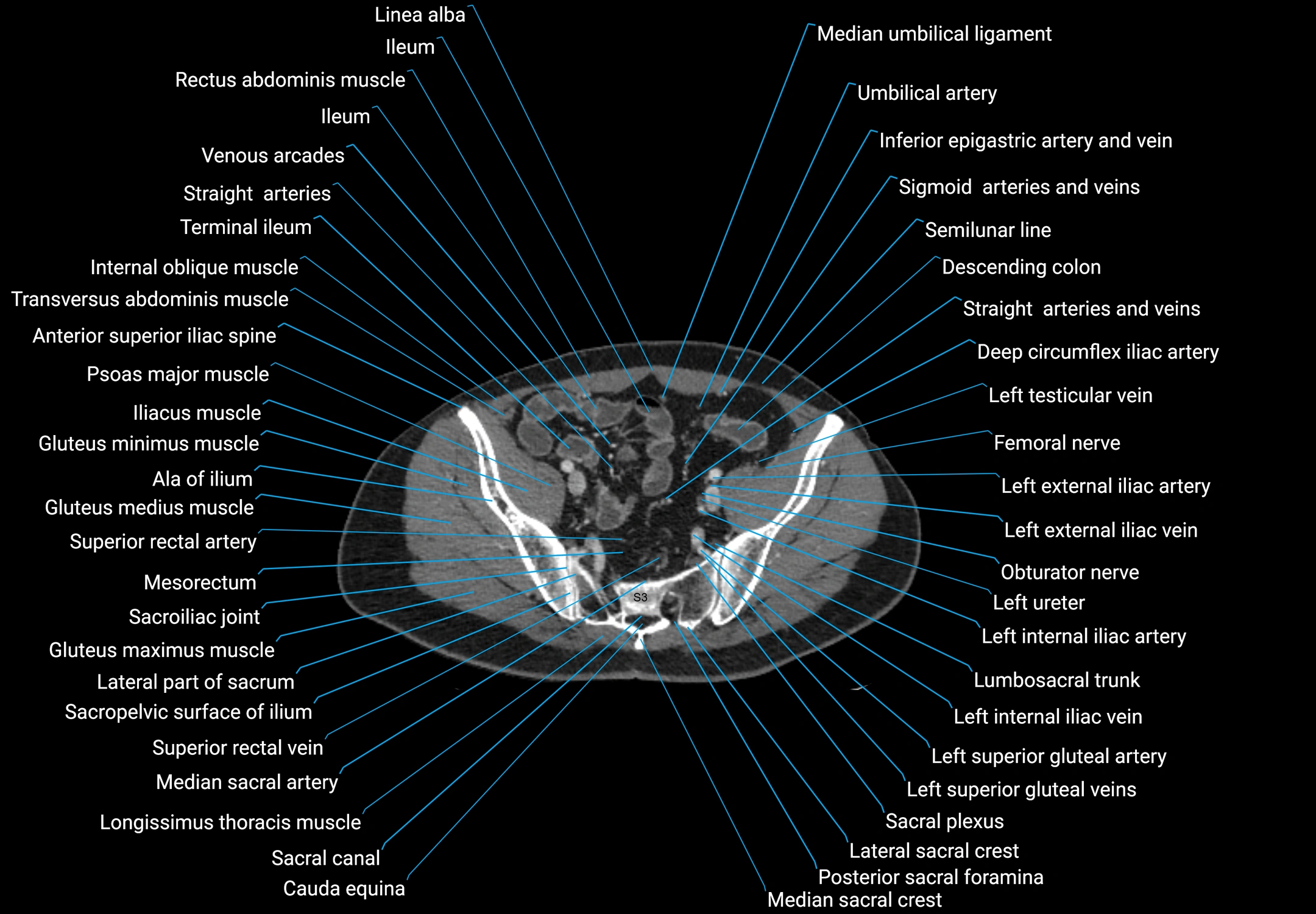 CT male pelvis axial cross sectional anatomy labelled radiology image -00156.webp